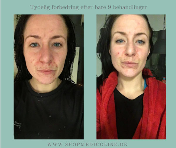 SKINLIGHT Lysterapimaske resultat