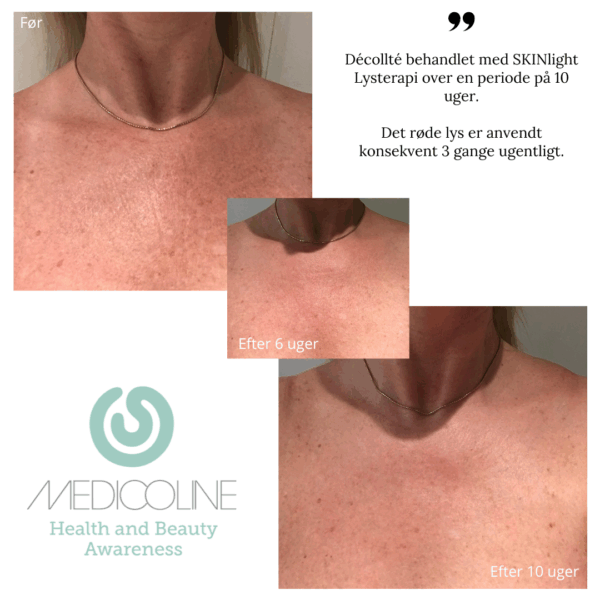 SKINlight PLUS Lysterapi Hals & Décolleté - Luksus version m. infrarød - Billede 6