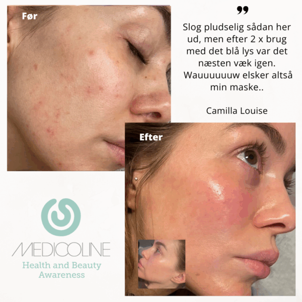 SKINlight PLUS lysterapi