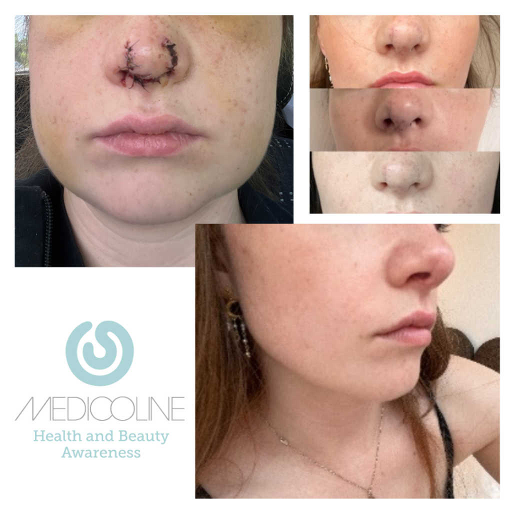 Brug af det røde lys til behandling af operations ar.