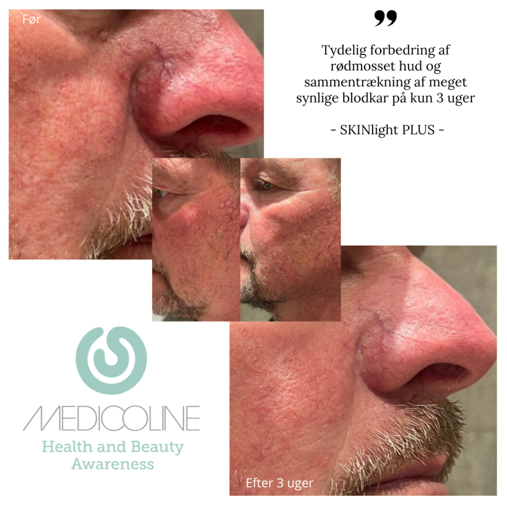 SKINlight PLUS Behandling af Karsprængninger