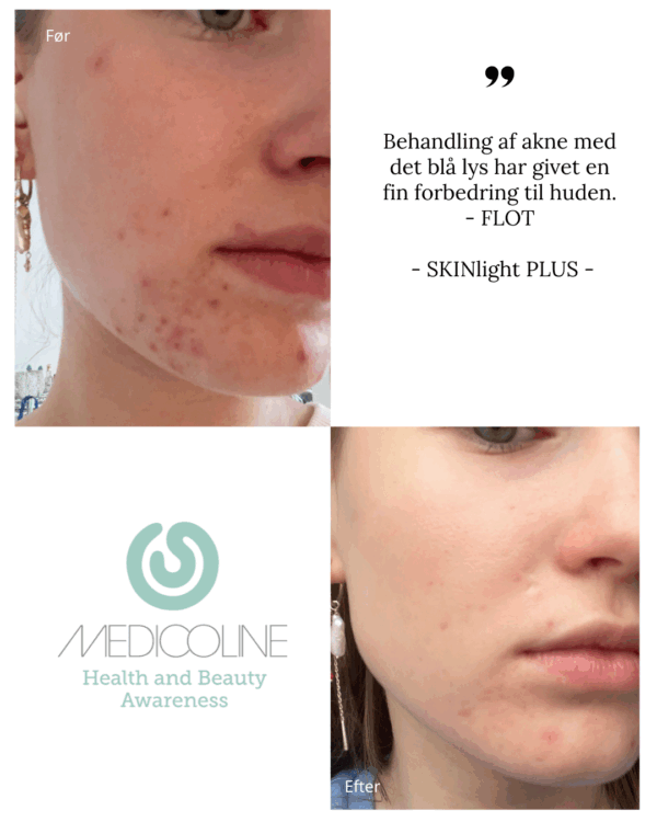 SKINlight PLUS akne