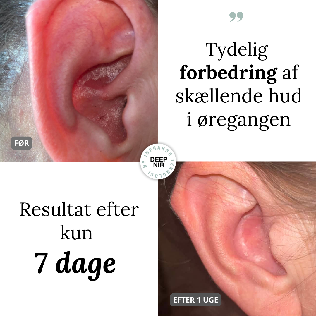 NYHED - SKINlight VITAL Lysterapi - Billede 5